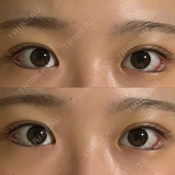 目尻切開 / タレ目形成・グラマラスライン（埋没） / 美容点滴・美容注射（美肌） LOUIS CLINIC 二子玉川院【ルイクリニック】 DAY 3 メイン用