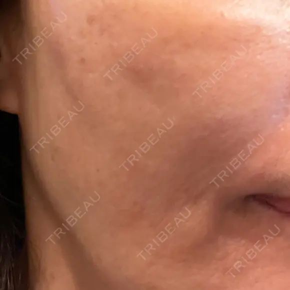 エレクトロポレーション / ピーリング（ハリ・ツヤ） LIFIX BEAUTY CLINIC AFTER メイン用