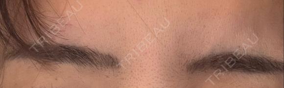 ボトックス（眉間） 湘南美容クリニック 博多院 DAY 7 メイン用