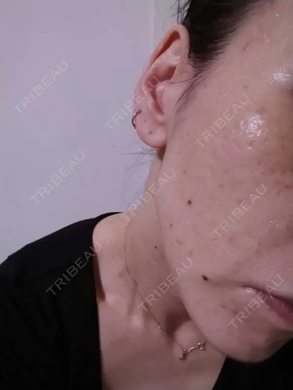 糸リフト / ヒアルロン酸注入（頬） ネビュラクリニック 広島院 DAY 12 メイン用