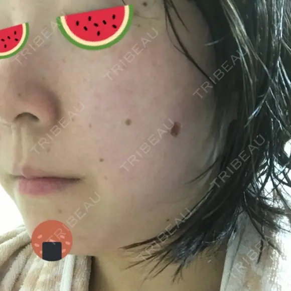 ほくろ・いぼ切除（肌） 甲府昭和形成外科クリニック DAY 2 メイン用
