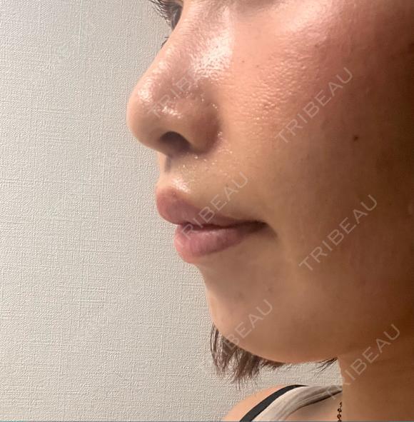 小鼻縮小（切開） / 人中短縮 / 鼻翼挙上 Otus Clinic 【オータスクリニック】 DAY 12 メイン用