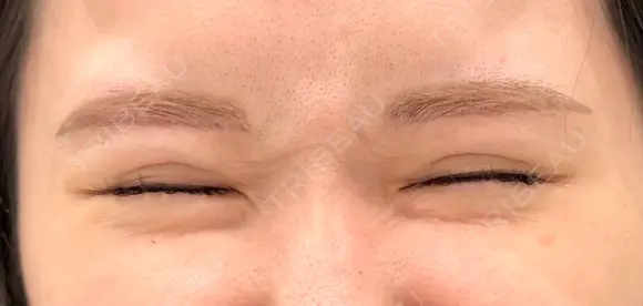 ボトックス（エラ・小顔） 美容皮膚科エルムクリニック 大阪院 DAY 3 メイン用