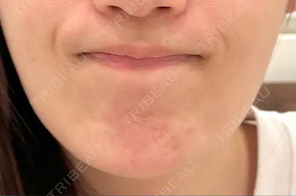 ボトックス（エラ・小顔） 美容皮膚科エルムクリニック 大阪院 DAY 3 メイン用