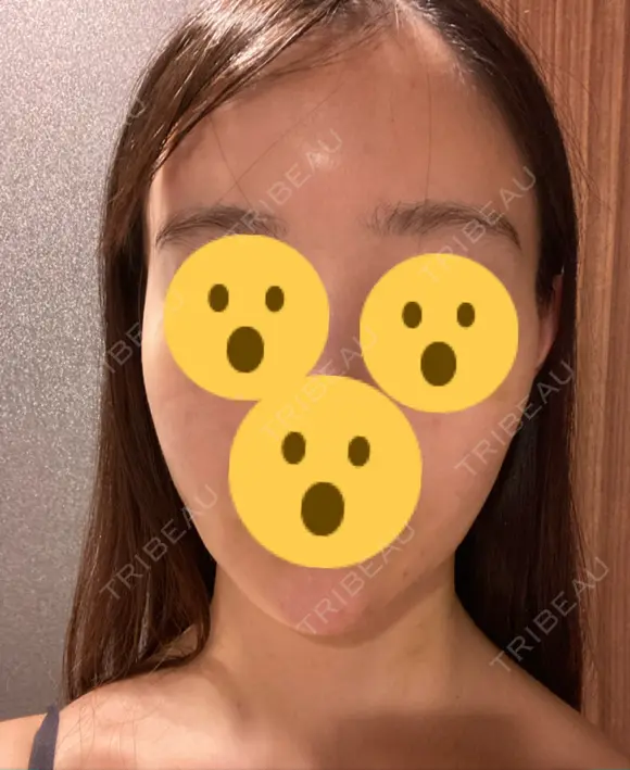 ハイフ（顔） リエンジャン整形外科 明洞店 DAY 6 メイン用