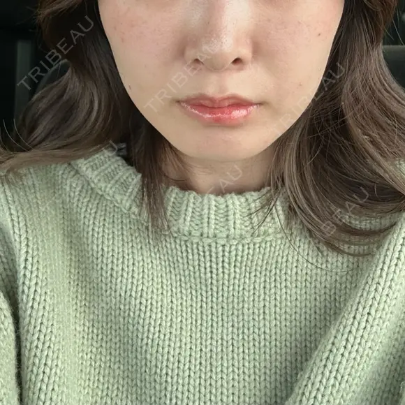 糸リフト / ヒアルロン酸注入（頬） EMMA CLINIC（エマクリニック） DAY 31 メイン用