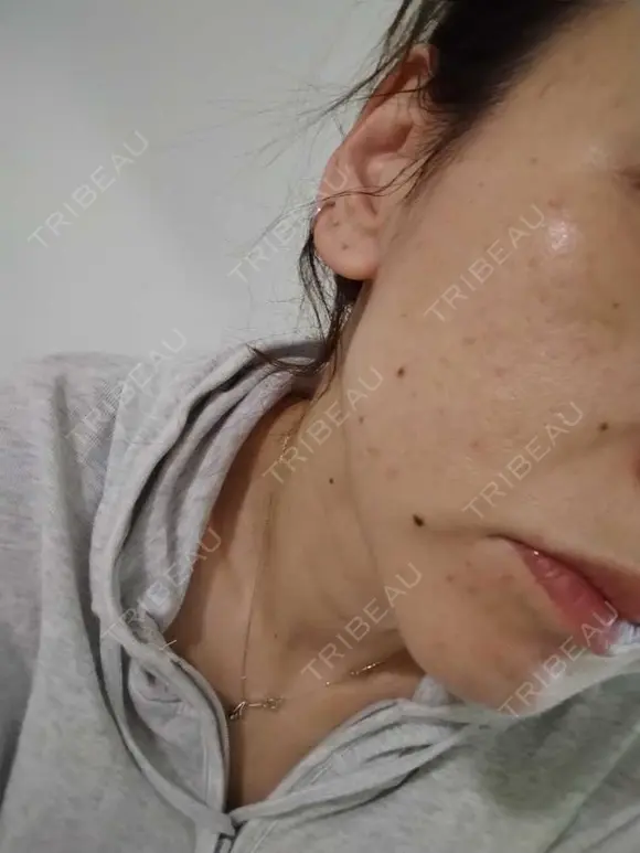 糸リフト / ヒアルロン酸注入（頬） ネビュラクリニック 広島院 DAY 14 メイン用