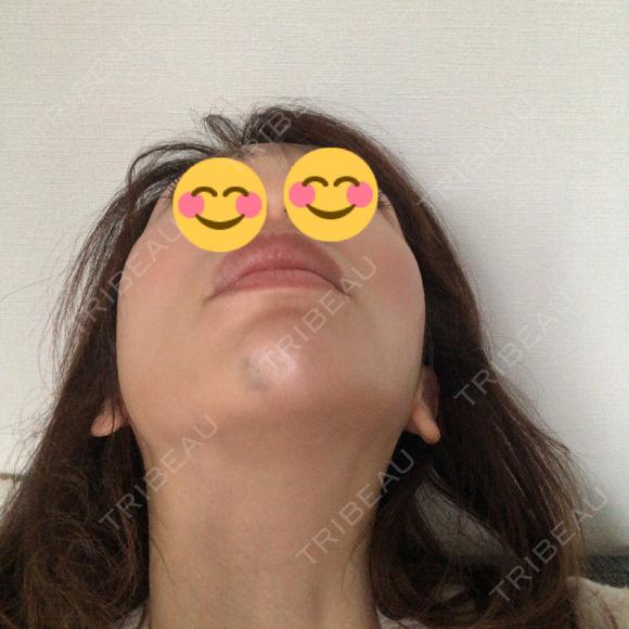 ボトックス（あご） TCB東京中央美容外科 柏院 AFTER メイン用