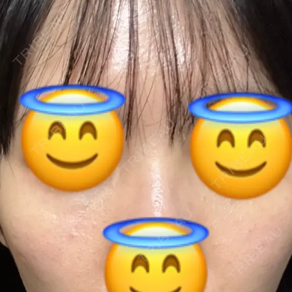 ヒアルロン酸注入（目の下） あじまビューティークリニック DAY 0 メイン用