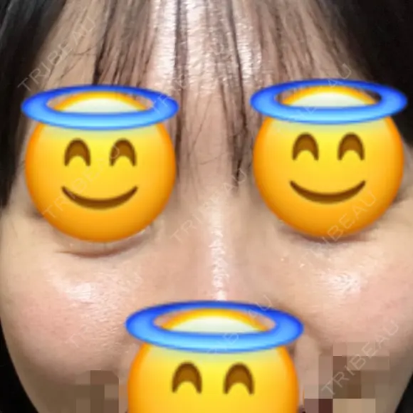 ヒアルロン酸注入（目の下） あじまビューティークリニック DAY 0 メイン用