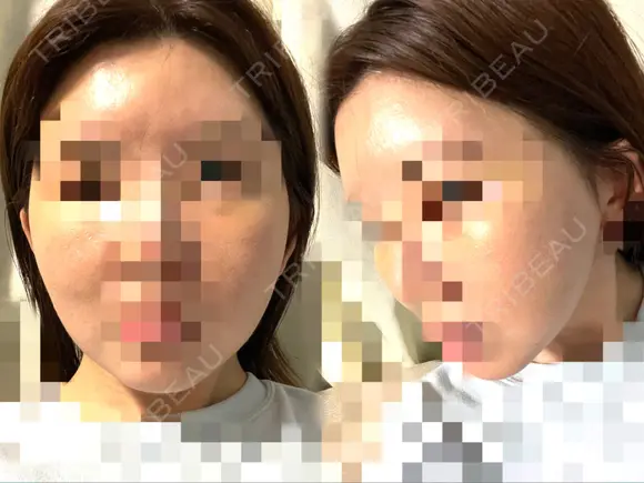 脂肪注入（額） GRACIA clinic 【グラシアクリニック】 DAY 8 メイン用