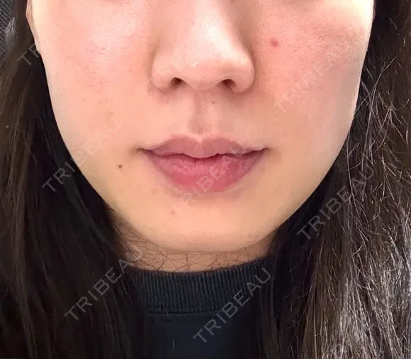 医療痩身（顔） リアルクリニック（REAL CLINIC） AFTER メイン用