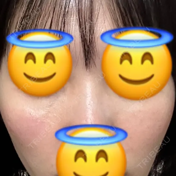 ヒアルロン酸注入（目の下） あじまビューティークリニック DAY 1 メイン用