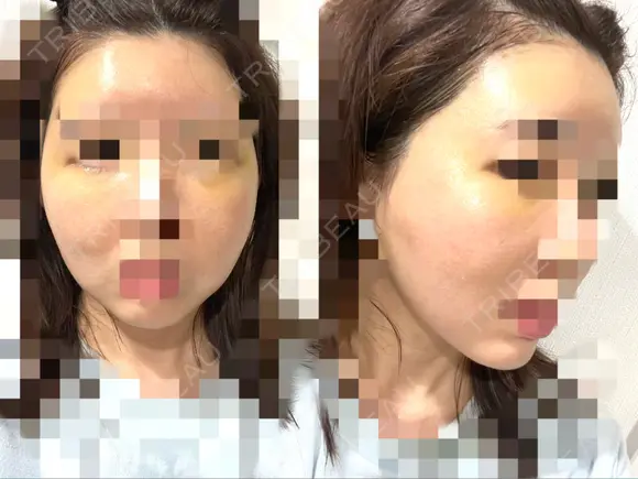 脂肪注入（額） GRACIA clinic 【グラシアクリニック】 DAY 9 メイン用