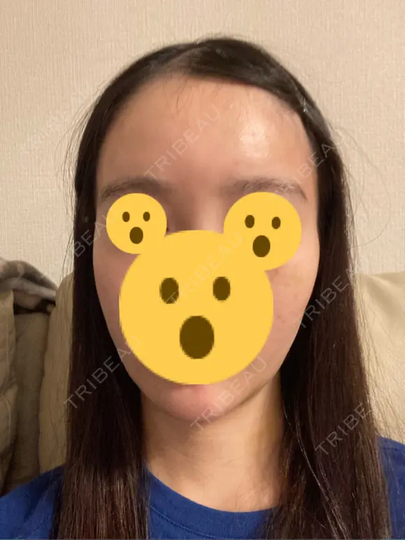 ハイフ（顔） リエンジャン整形外科 明洞店 DAY 8 メイン用