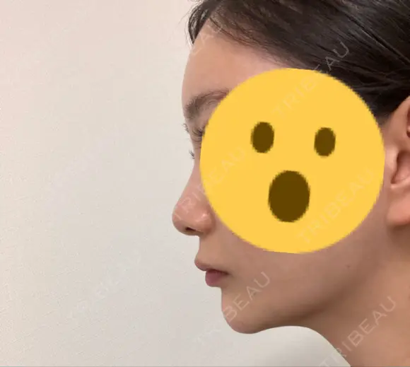 ハイフ（顔） リエンジャン整形外科 明洞店 DAY 9 メイン用