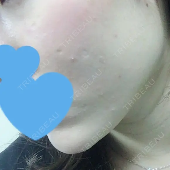 糸リフト / ヒアルロン酸注入（あご） / ボトックス（エラ・小顔） / 脂肪溶解注射（顔） TCB東京中央美容外科 郡山院 DAY 10 メイン用