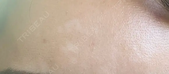 シミ取りレーザー Mavie Beauty Clinic （マヴィービューティークリニック） DAY 22 メイン用