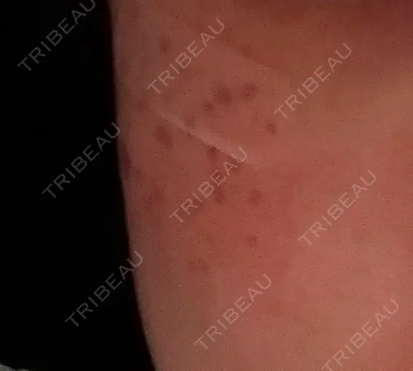 シミ取りレーザー / YAGレーザー 新宿美容外科クリニック 新宿院 DAY 4 メイン用