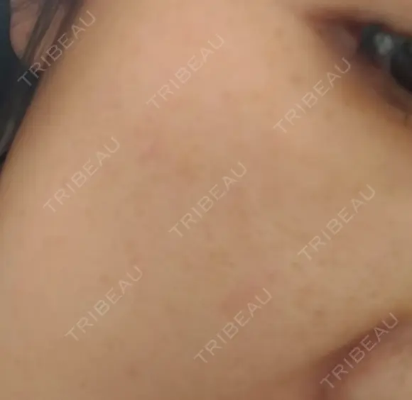 シミ取りレーザー / YAGレーザー 新宿美容外科クリニック 新宿院 AFTER メイン用