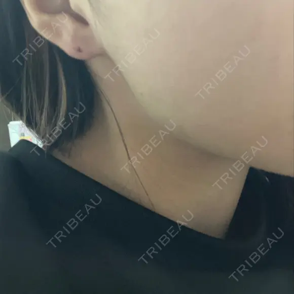 ボトックス（エラ・小顔） TCB東京中央美容外科 小倉院 AFTER メイン用