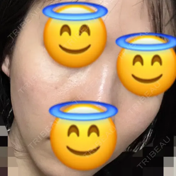 ヒアルロン酸注入（目の下） あじまビューティークリニック DAY 2 メイン用