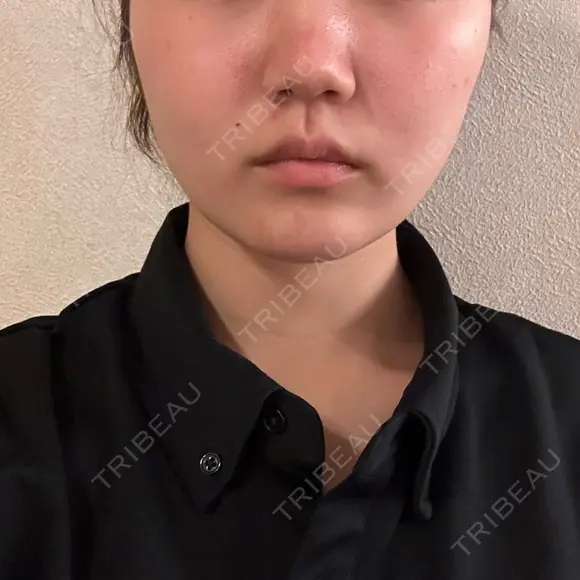 バッカルファット除去 / 脂肪吸引（顔） 湘南美容クリニック 京都院 DAY 101 メイン用