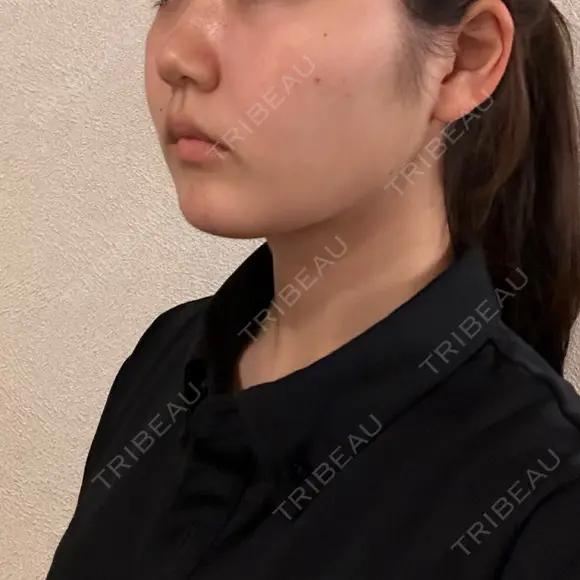 バッカルファット除去 / 脂肪吸引（顔） 湘南美容クリニック 京都院 DAY 101 メイン用