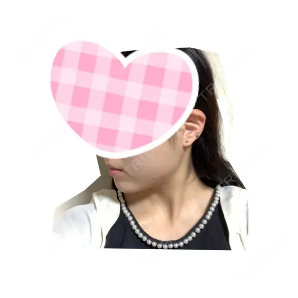 バッカルファット除去 / 脂肪吸引（顔） / ヒアルロン酸注入（涙袋） / ヒアルロン酸注入（鼻） / ヒアルロン酸注入（あご） / ボトックス（エラ・小顔） エートップ美容整形外科 DAY 31 メイン用