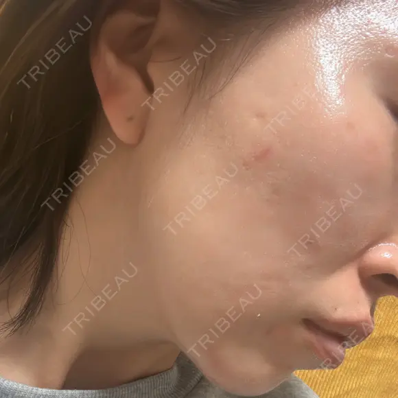 その他（肌） / ダーマペン ジョウクリニック 那覇院 AFTER メイン用