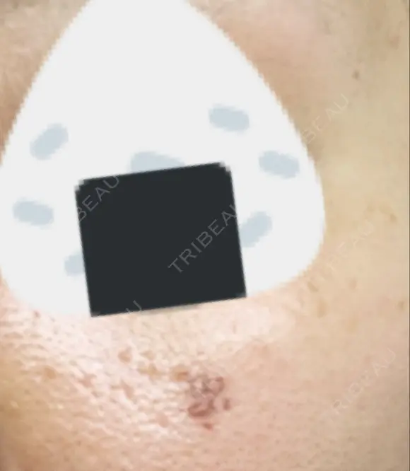 シミ取りレーザー 渋谷美容外科クリニック 横浜院 DAY 5 メイン用