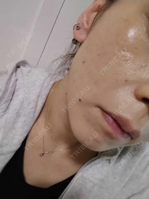 糸リフト / ヒアルロン酸注入（頬） ネビュラクリニック 広島院 DAY 21 メイン用