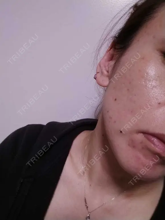 糸リフト / ヒアルロン酸注入（頬） ネビュラクリニック 広島院 DAY 14 メイン用