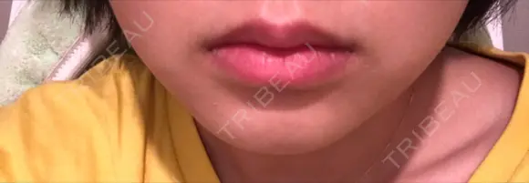 脂肪溶解注射（まぶた） 横浜中央クリニック 横浜院 AFTER メイン用