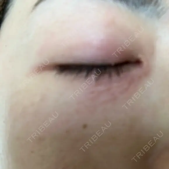 ニードルRF（ポテンツァなど） 表参道スキンクリニック 名古屋院（DAILY SKIN CLINIC提携院） DAY 0 メイン用