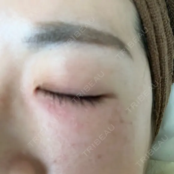 ニードルRF（ポテンツァなど） 表参道スキンクリニック 名古屋院（DAILY SKIN CLINIC提携院） DAY 0 メイン用