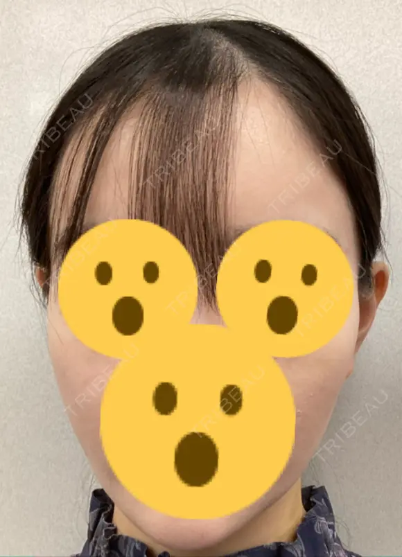 ハイフ（顔） リエンジャン整形外科 明洞店 DAY 9 メイン用