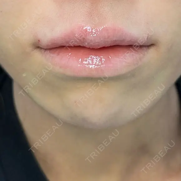 ヒアルロン酸注入（唇） / ボトックス（口角） / その他（輪郭） ルラ美容クリニック 渋谷本院 AFTER メイン用