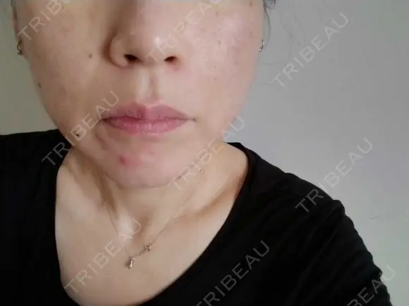 糸リフト / ヒアルロン酸注入（頬） ネビュラクリニック 広島院 AFTER メイン用