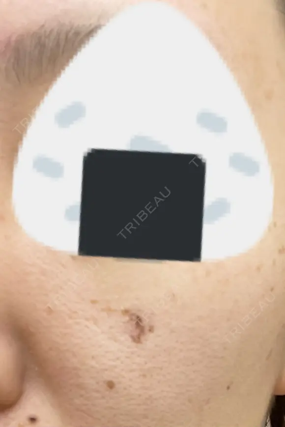 シミ取りレーザー 渋谷美容外科クリニック 横浜院 DAY 7 メイン用