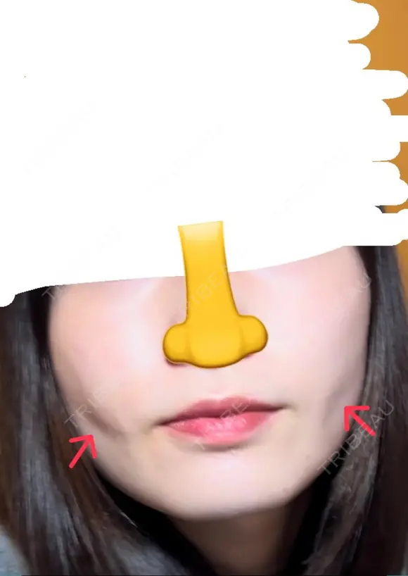 糸リフト / 脂肪吸引（顔） / ジョールファット除去 / ボトックス（エラ・小顔） ルラ美容クリニック 新宿院 DAY 45 メイン用