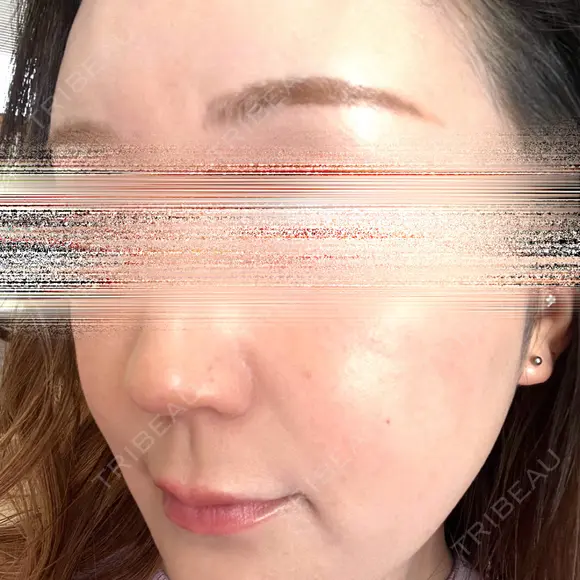 ハイフ（顔） 湘南美容クリニック 岐阜院 DAY 1 メイン用