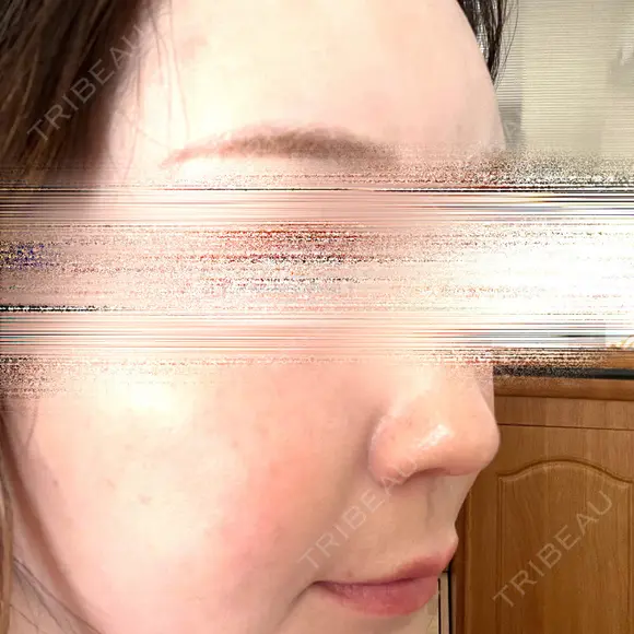 ハイフ（顔） 湘南美容クリニック 岐阜院 DAY 1 メイン用