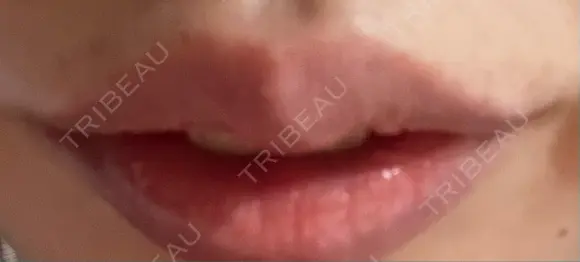 ヒアルロン酸注入（唇） 橿原 BEAUTY CLINIC DAY 7 メイン用