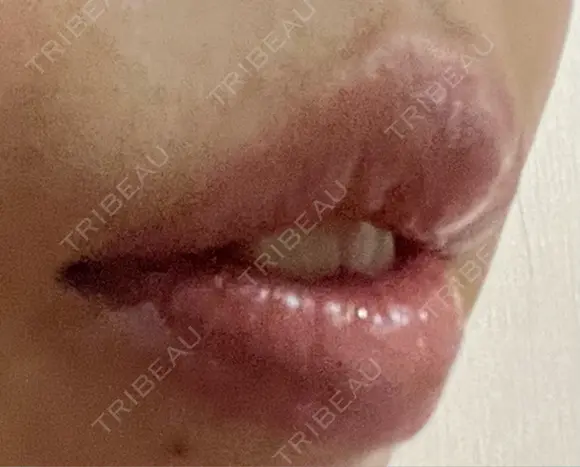 ヒアルロン酸注入（唇） 橿原 BEAUTY CLINIC DAY 7 メイン用
