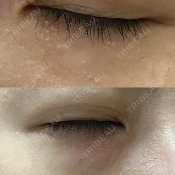 ニードルRF（ポテンツァなど） 表参道スキンクリニック 名古屋院（DAILY SKIN CLINIC提携院） DAY 2 メイン用