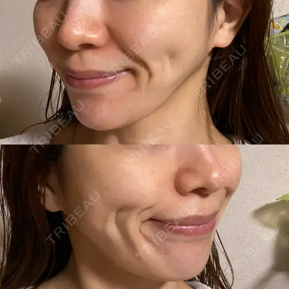 糸リフト / 脂肪吸引注射（顔） 湘南美容クリニック 名古屋栄院 AFTER メイン用