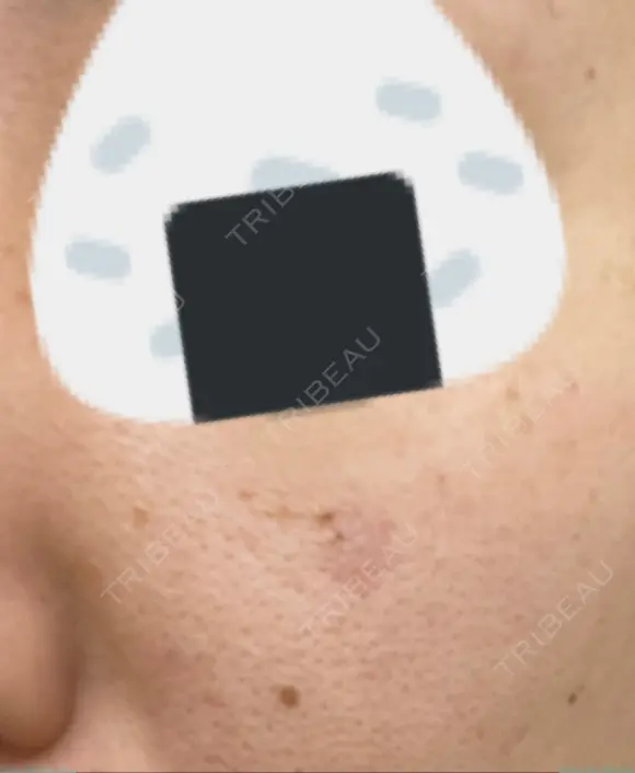 シミ取りレーザー 渋谷美容外科クリニック 横浜院 AFTER メイン用