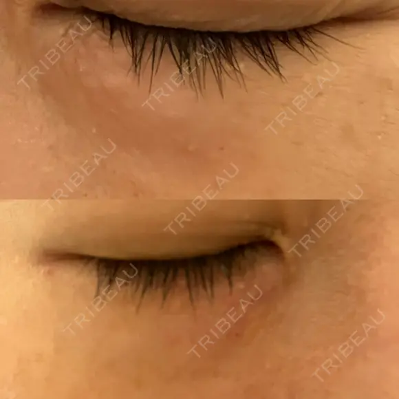 ニードルRF（ポテンツァなど） 表参道スキンクリニック 名古屋院（DAILY SKIN CLINIC提携院） DAY 3 メイン用