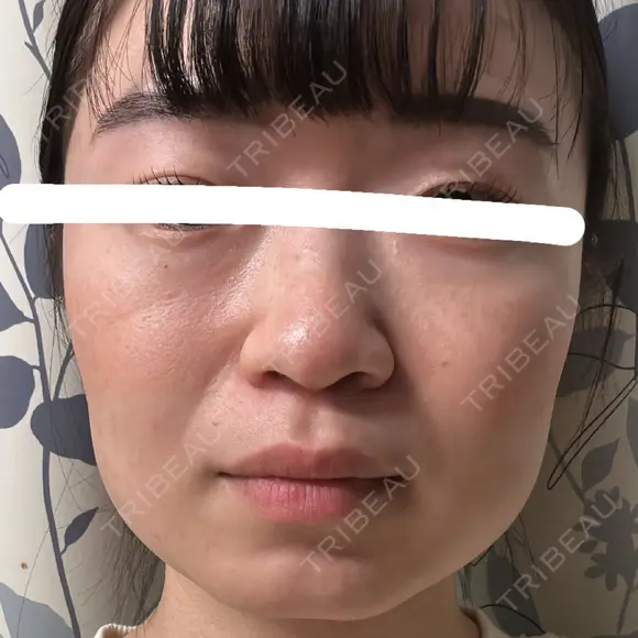 ボトックス（エラ・小顔） 湘南美容クリニック 金山院 DAY 3 メイン用